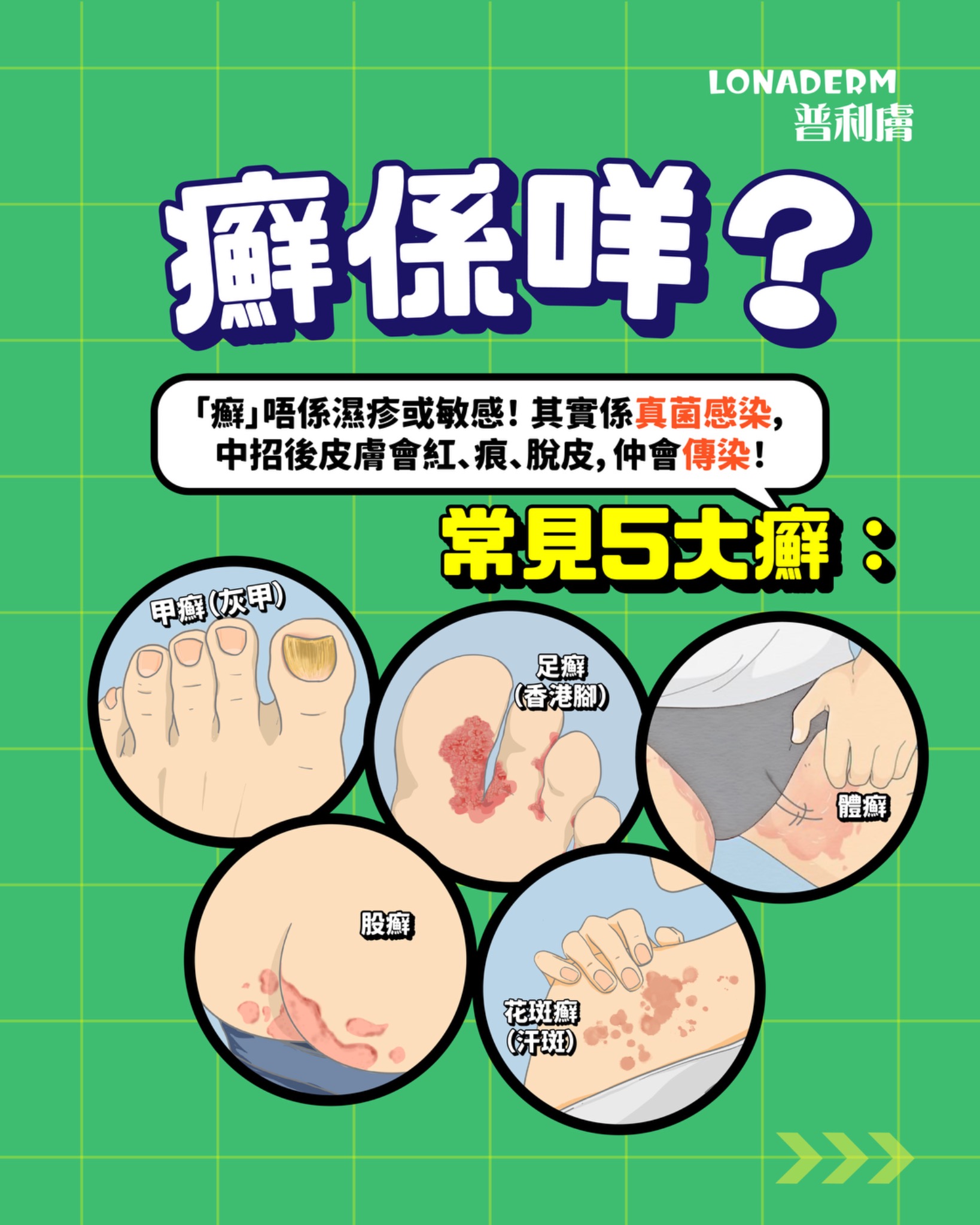 癬係咩